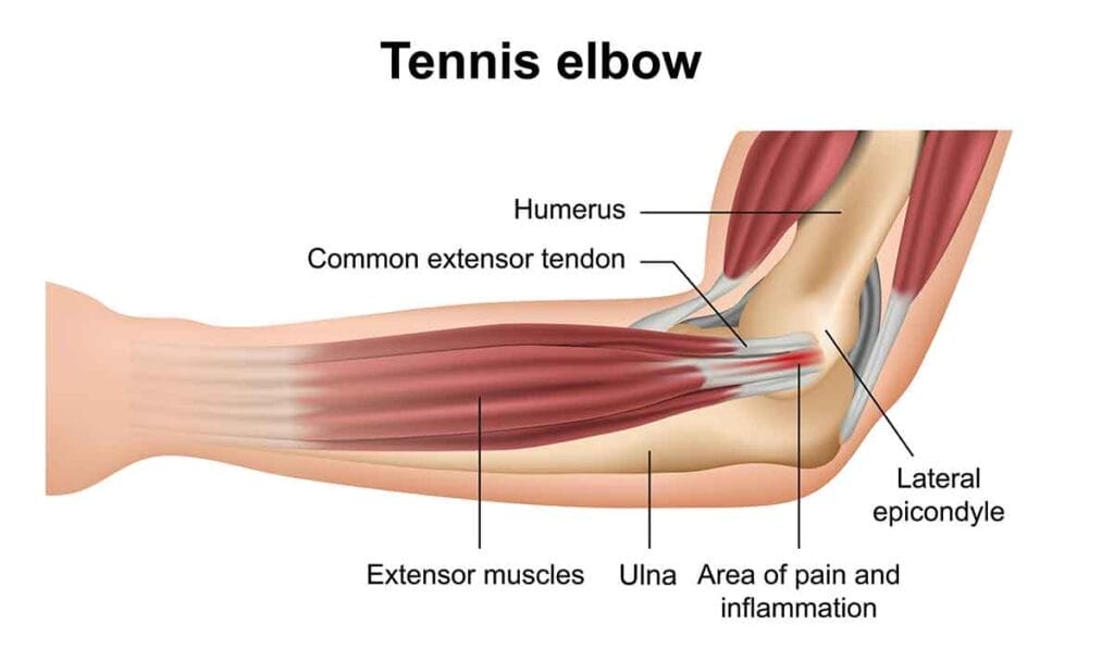 Diagram of an elbow with labeled parts, describing "tennis elbow." Areas labeled include the humerus, common extensor tendon, lateral epicondyle, extensor muscles, ulna, and an area of pain and inflammation.