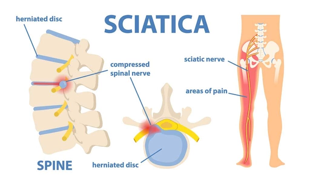 Infografía que muestra la ciática: diagrama de la columna vertebral con hernia de disco, nervio raquídeo comprimido y áreas de dolor desde la parte inferior de la espalda hasta la pierna. Las etiquetas de texto incluyen "nervio ciático" y "áreas de dolor".