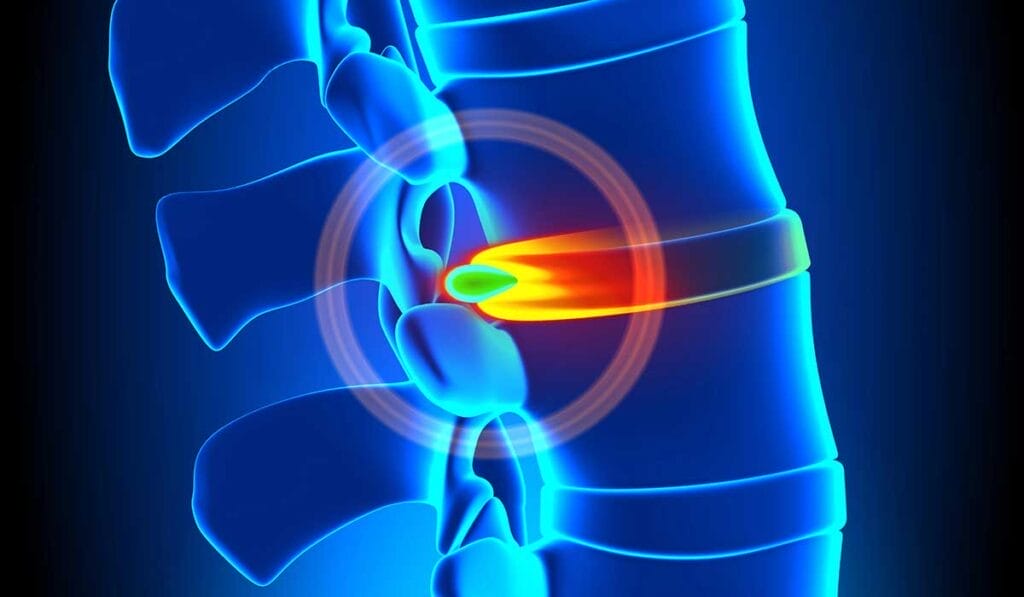 Ilustración médica de la columna vertebral humana, en la que se destaca un disco herniado entre dos vértebras. El disco se muestra protuberante y el color rojo y amarillo denota inflamación o presión.